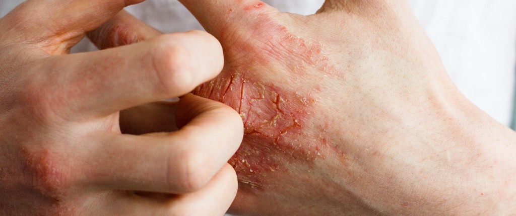 skin infection in nursing home (1)